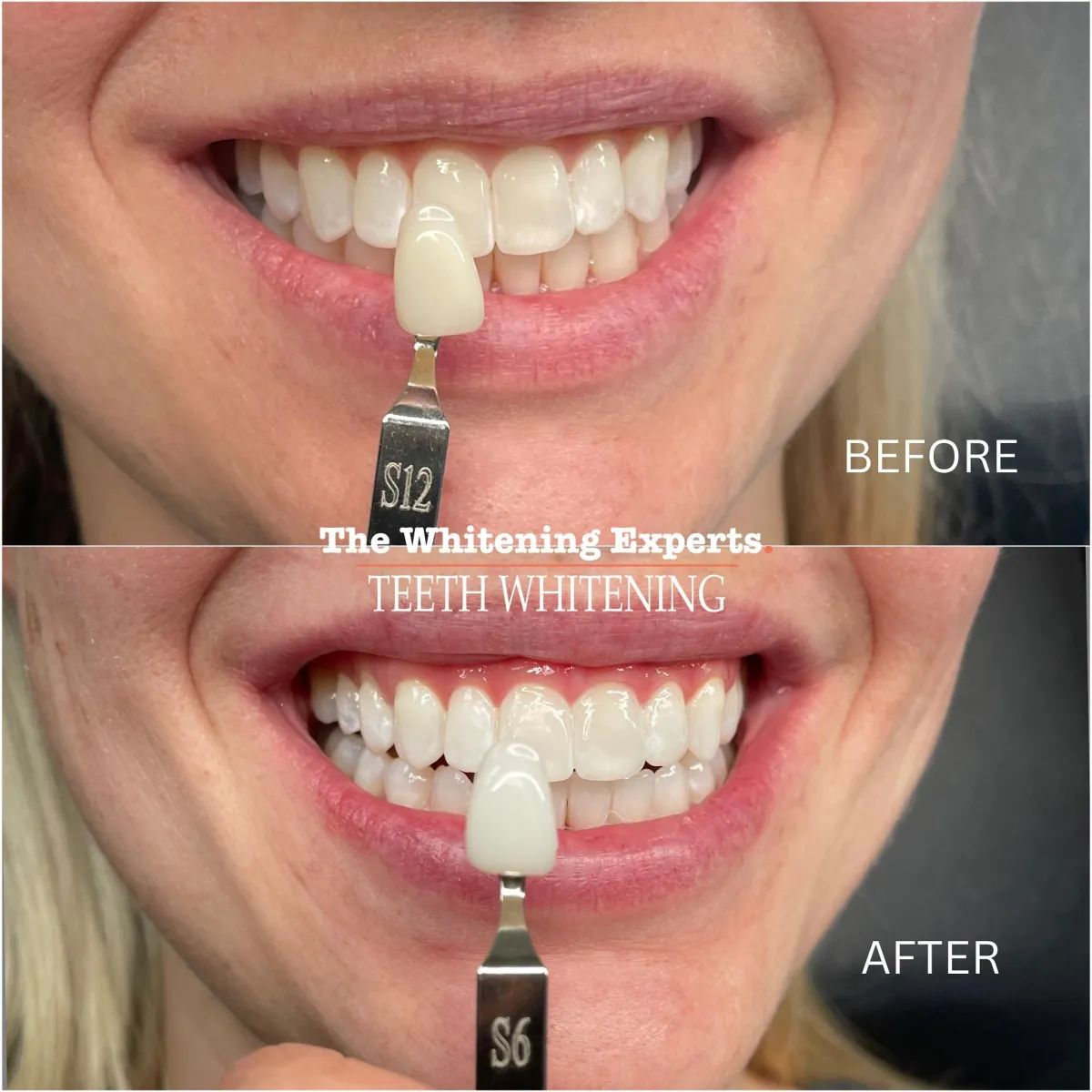 Before and after teeth whitening result at The Whitening Experts